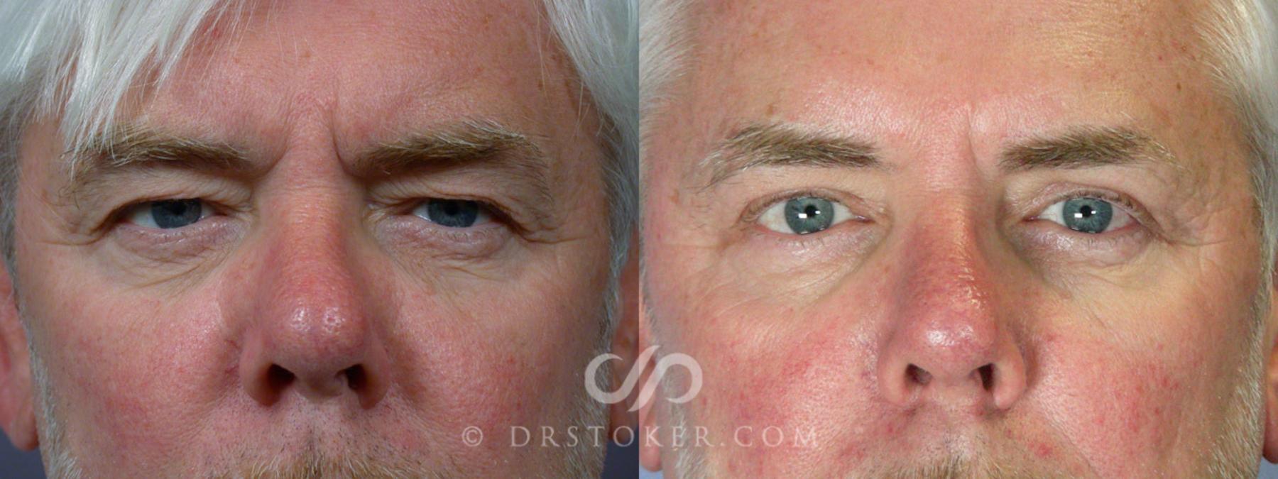 Before & After Eyelid Surgery Case 246 View #1 View in Los Angeles, CA