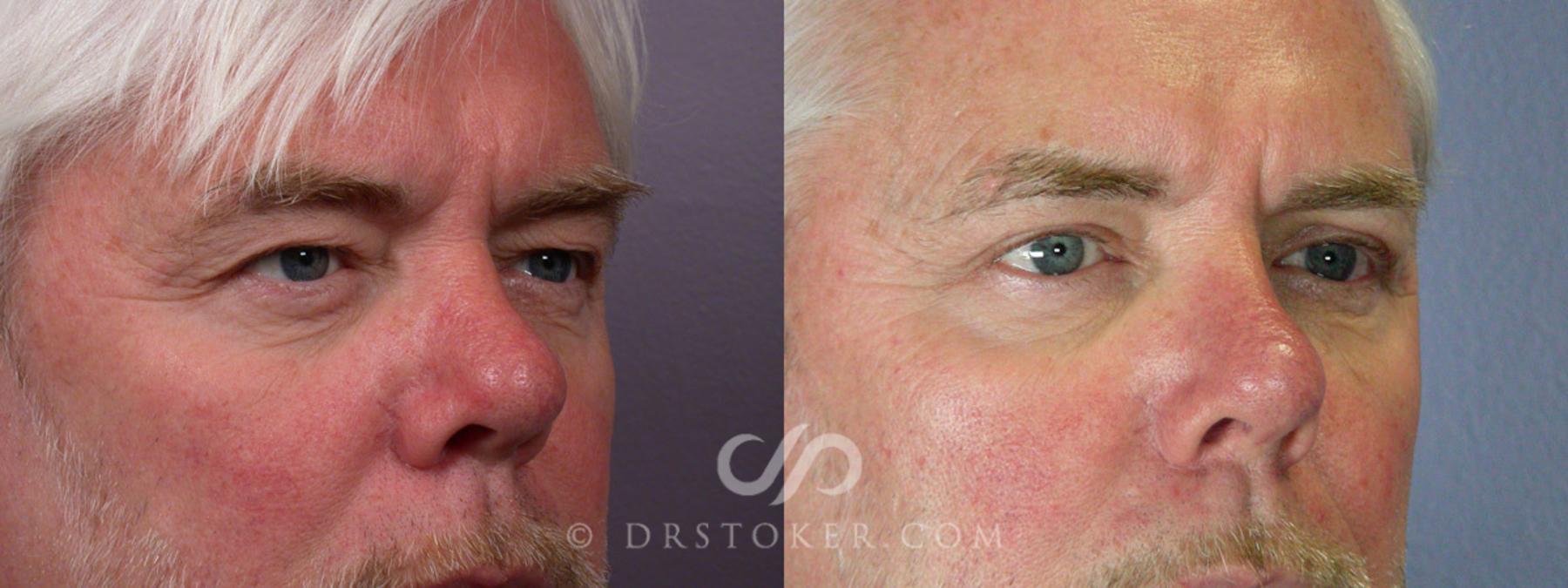 Before & After Eyelid Surgery for Men Case 246 View #2 View in Los Angeles, CA