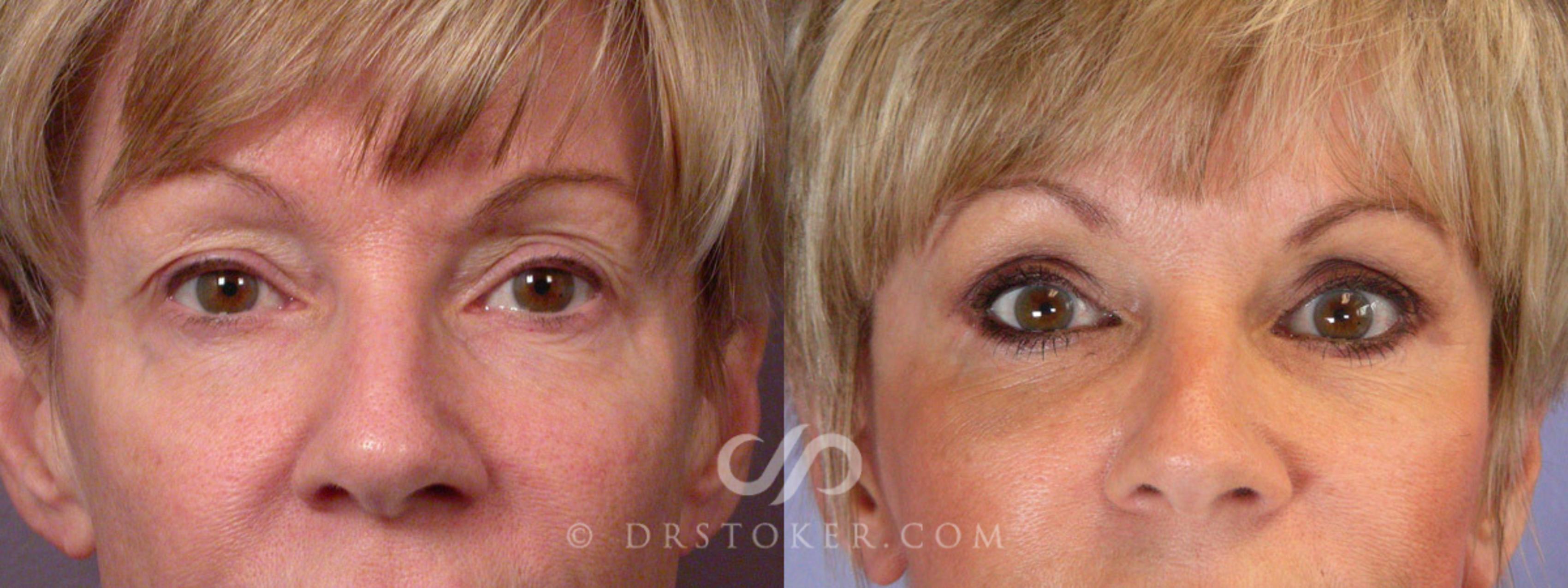 Before & After Eyelid Surgery Case 247 View #1 View in Los Angeles, CA