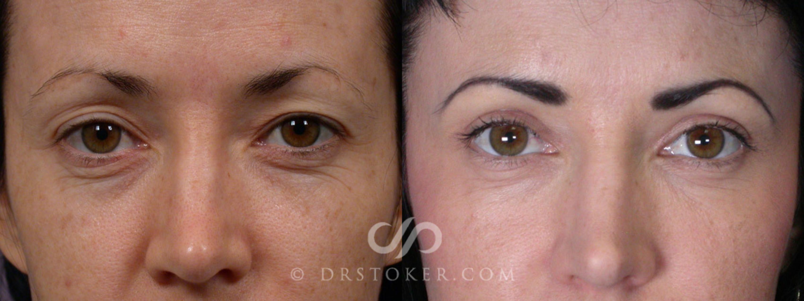 Before & After Eyelid Surgery Case 248 View #1 View in Marina del Rey, CA