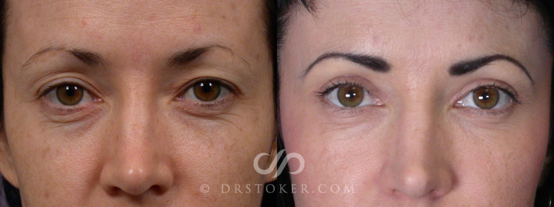 Before & After Eyelid Surgery Case 248 View #1 View in Los Angeles, CA