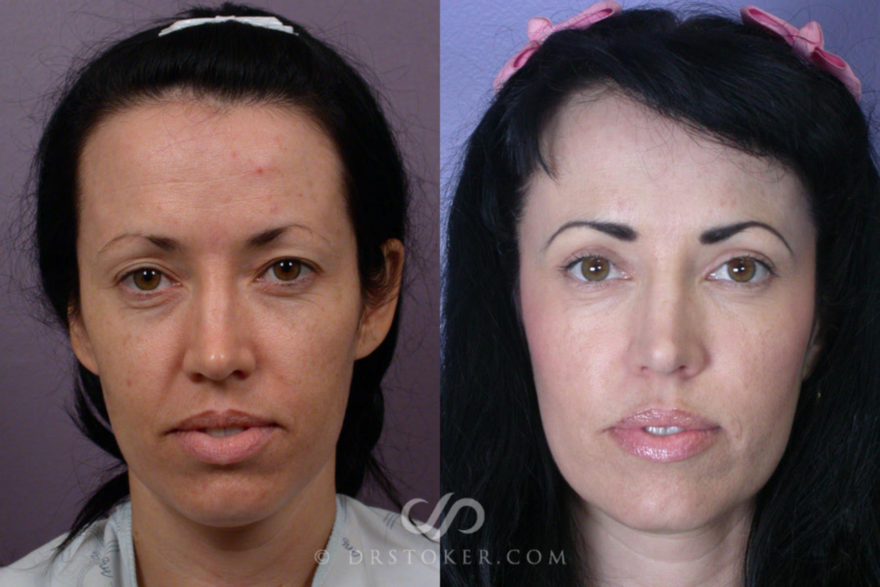 Before & After Eyelid Surgery Case 248 View #2 View in Los Angeles, CA
