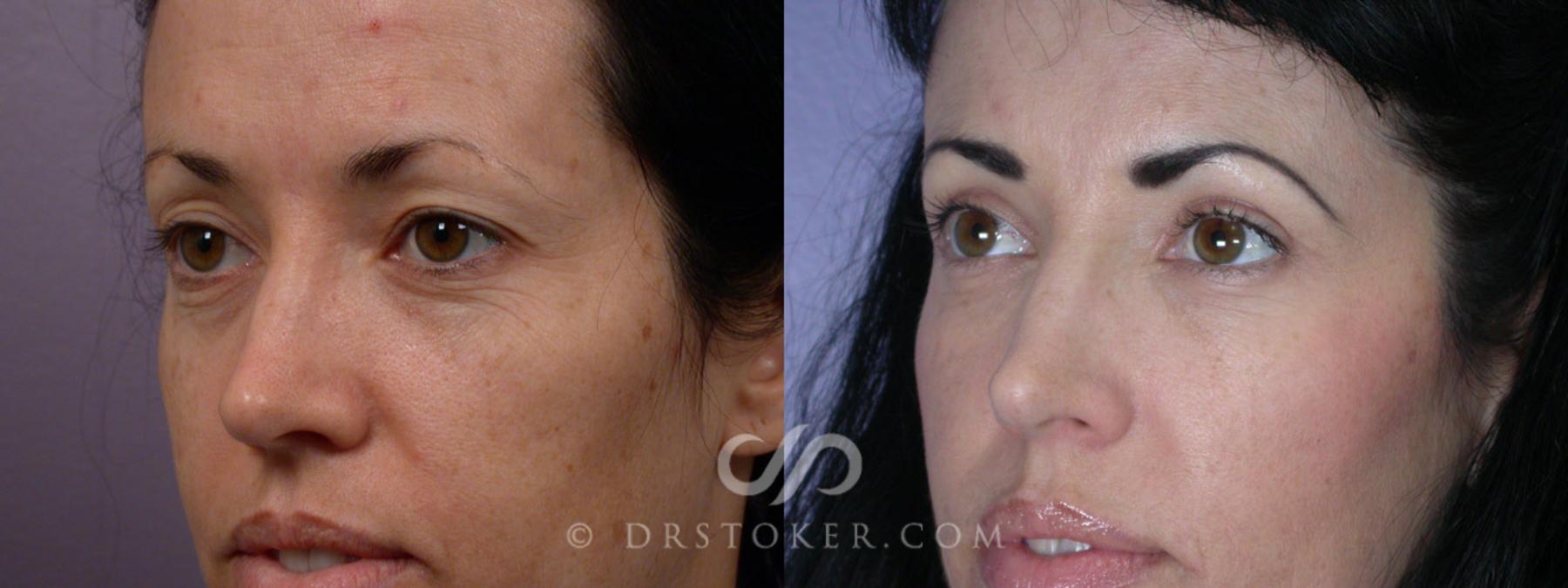 Before & After Eyelid Surgery Case 248 View #3 View in Los Angeles, CA
