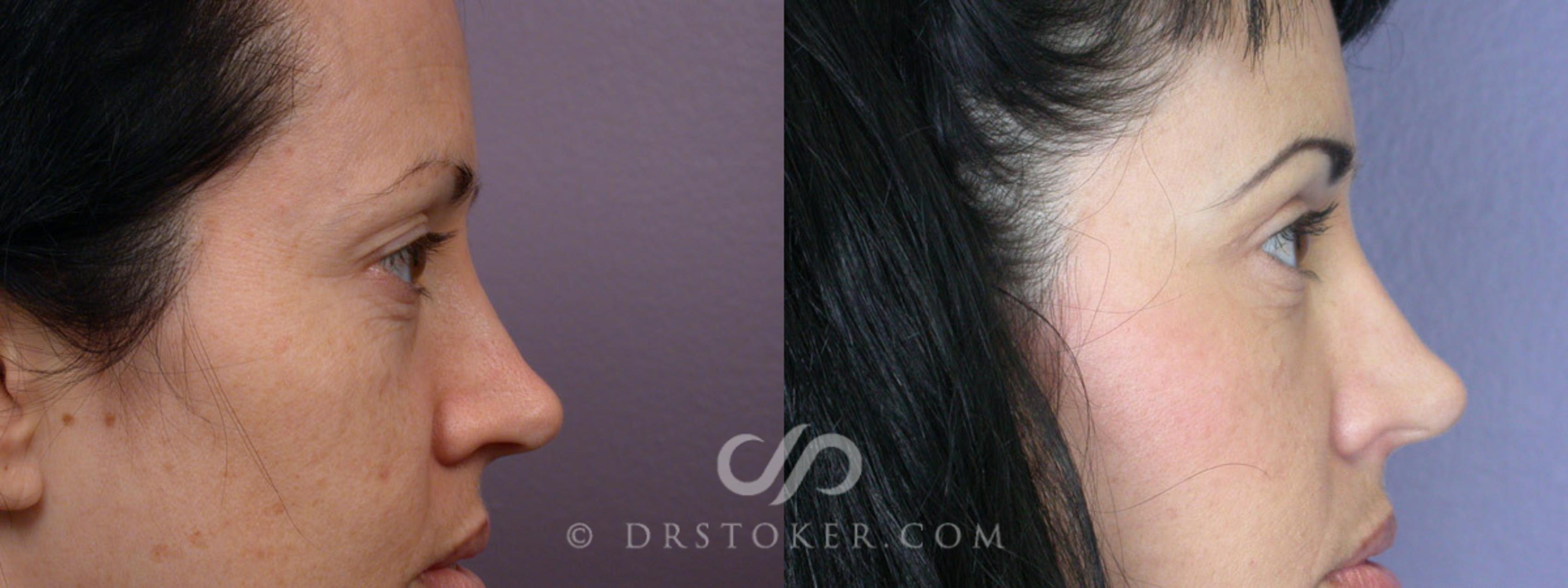 Before & After Eyelid Surgery Case 248 View #4 View in Los Angeles, CA