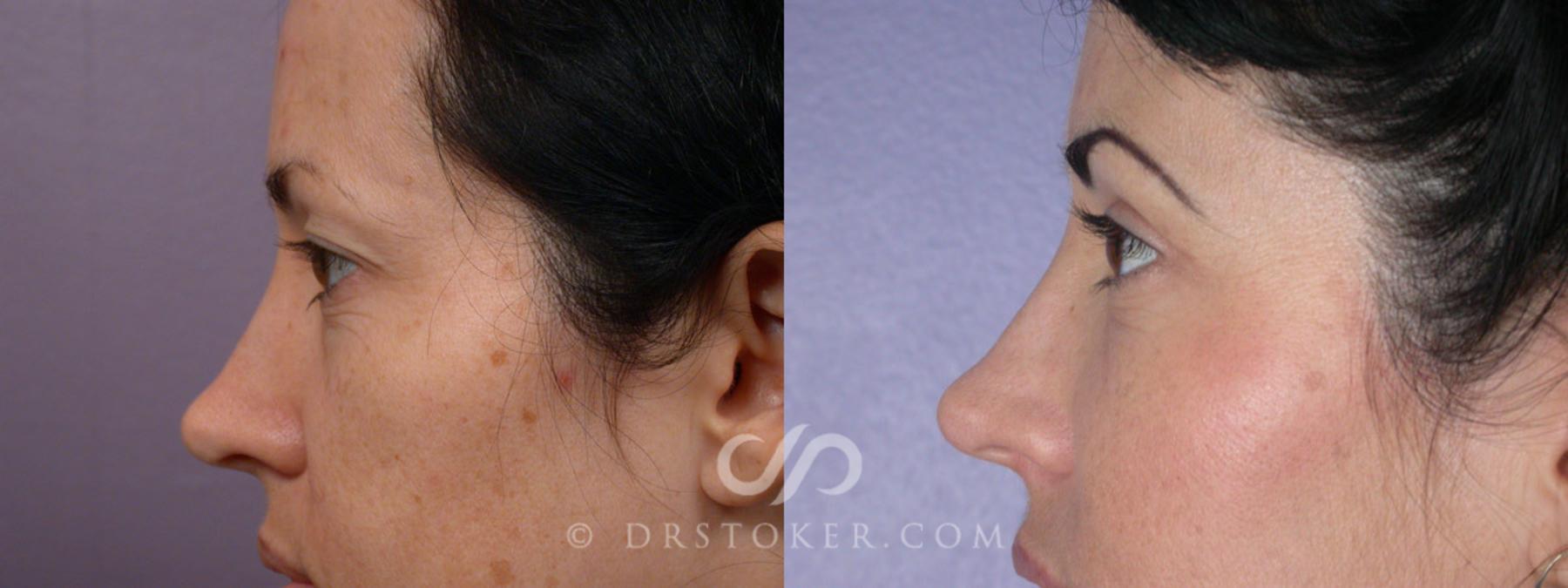 Before & After Eyelid Surgery Case 248 View #5 View in Los Angeles, CA