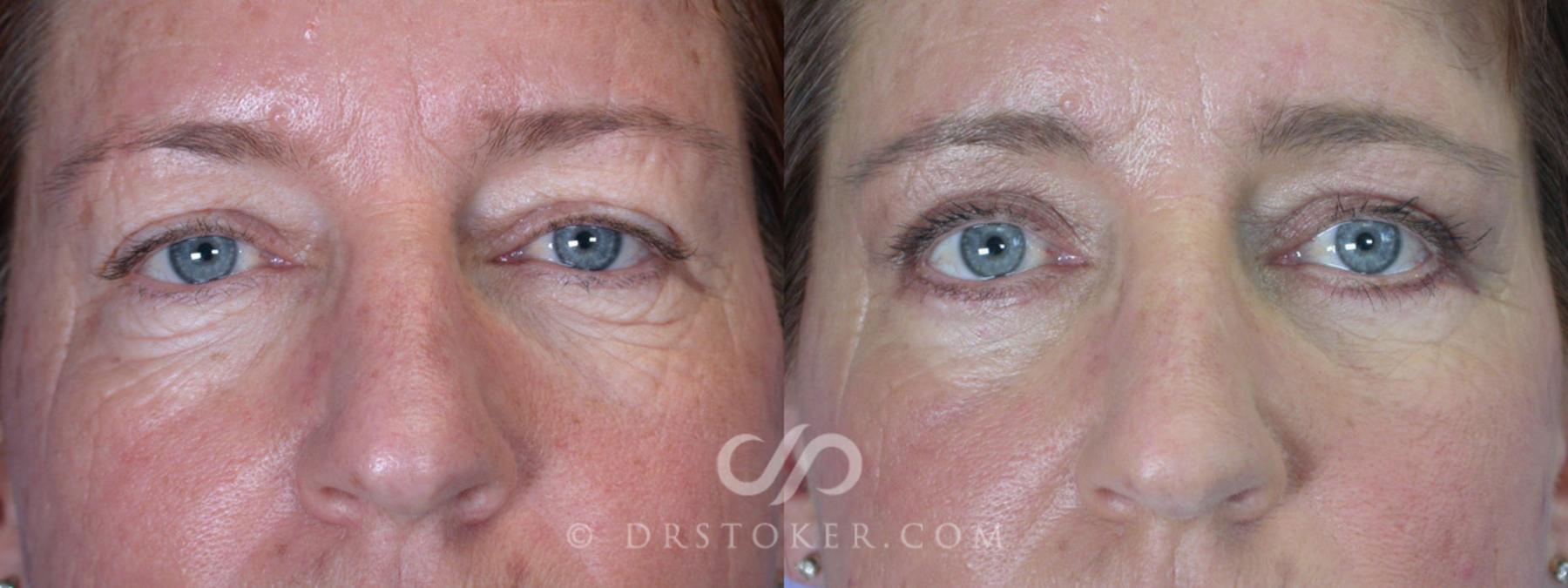 Before & After Eyelid Surgery Case 249 View #1 View in Los Angeles, CA
