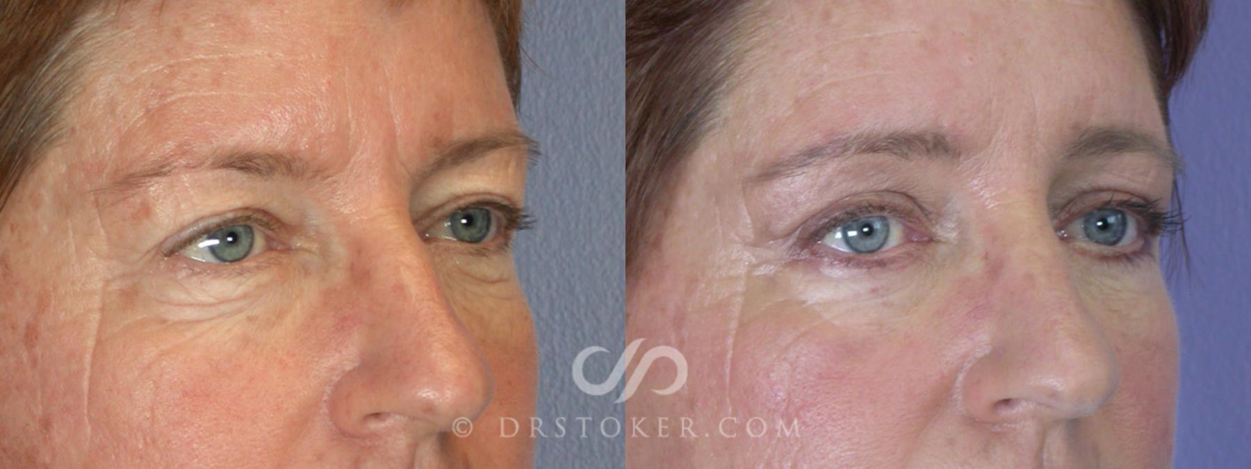 Before & After Eyelid Surgery Case 249 View #2 View in Los Angeles, CA
