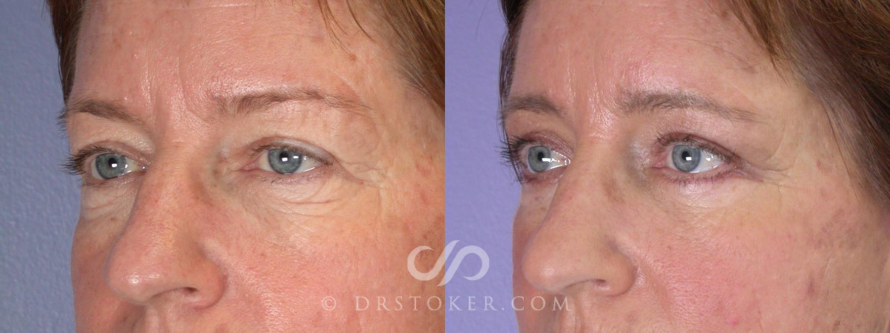 Before & After Eyelid Surgery Case 249 View #3 View in Los Angeles, CA