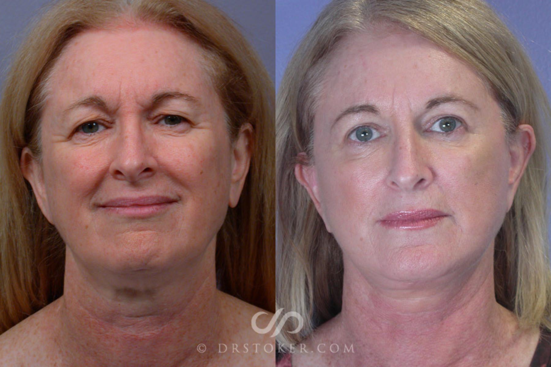 Before & After Eyelid Surgery Case 250 View #1 View in Los Angeles, CA