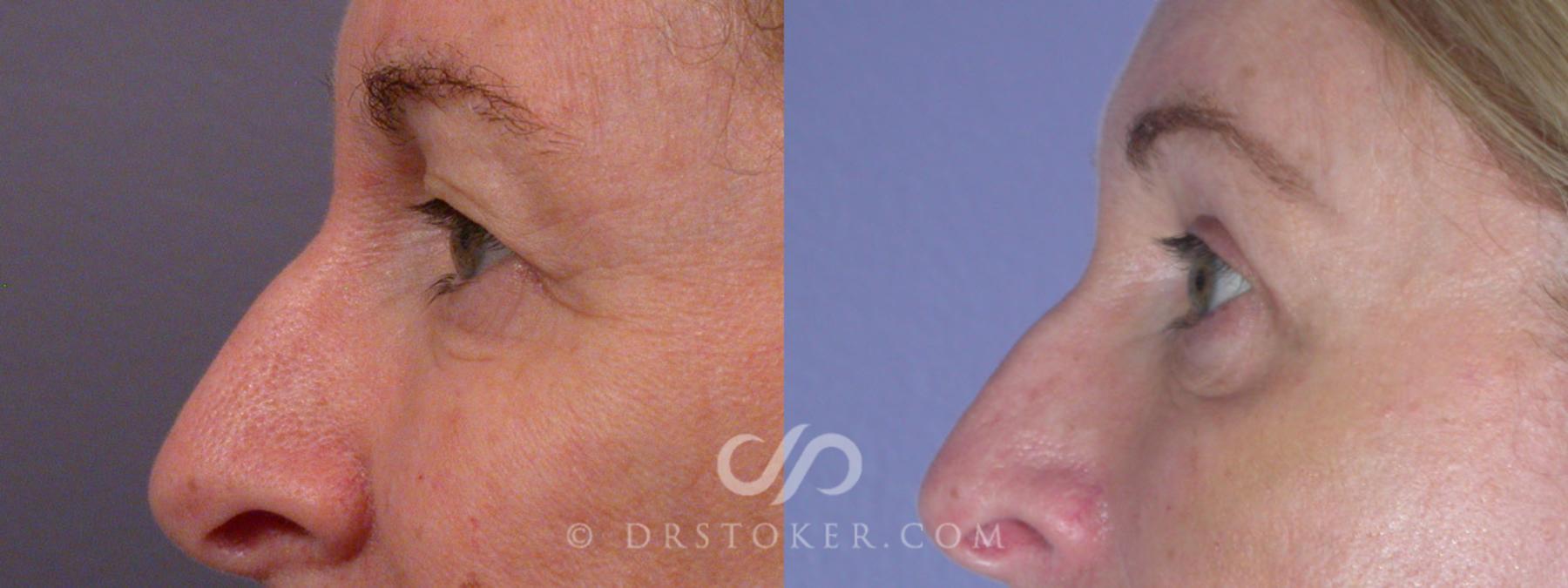 Before & After Eyelid Surgery Case 250 View #10 View in Los Angeles, CA