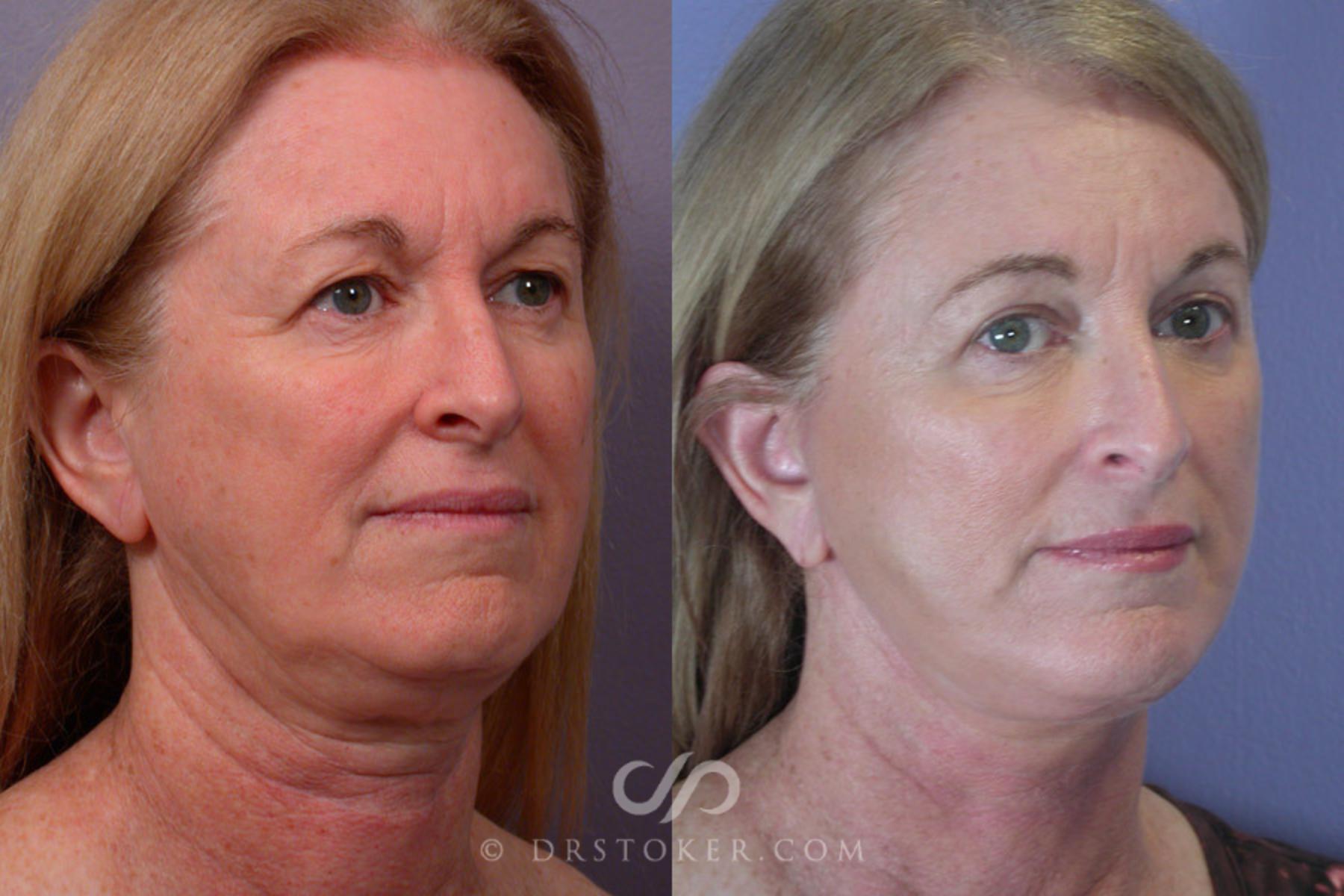 Before & After Neck Lift - Traceless Neck Lift  Case 250 View #2 View in Los Angeles, CA