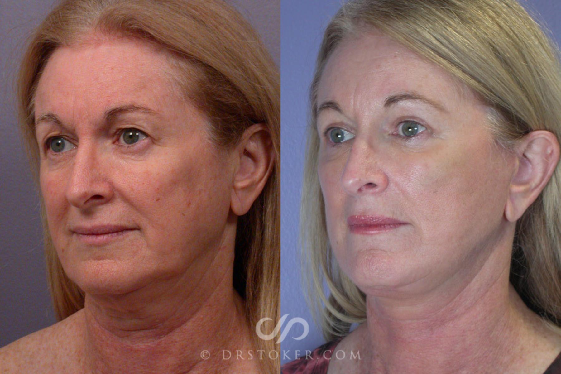 Before & After Neck Lift - Traceless Neck Lift  Case 250 View #3 View in Los Angeles, CA