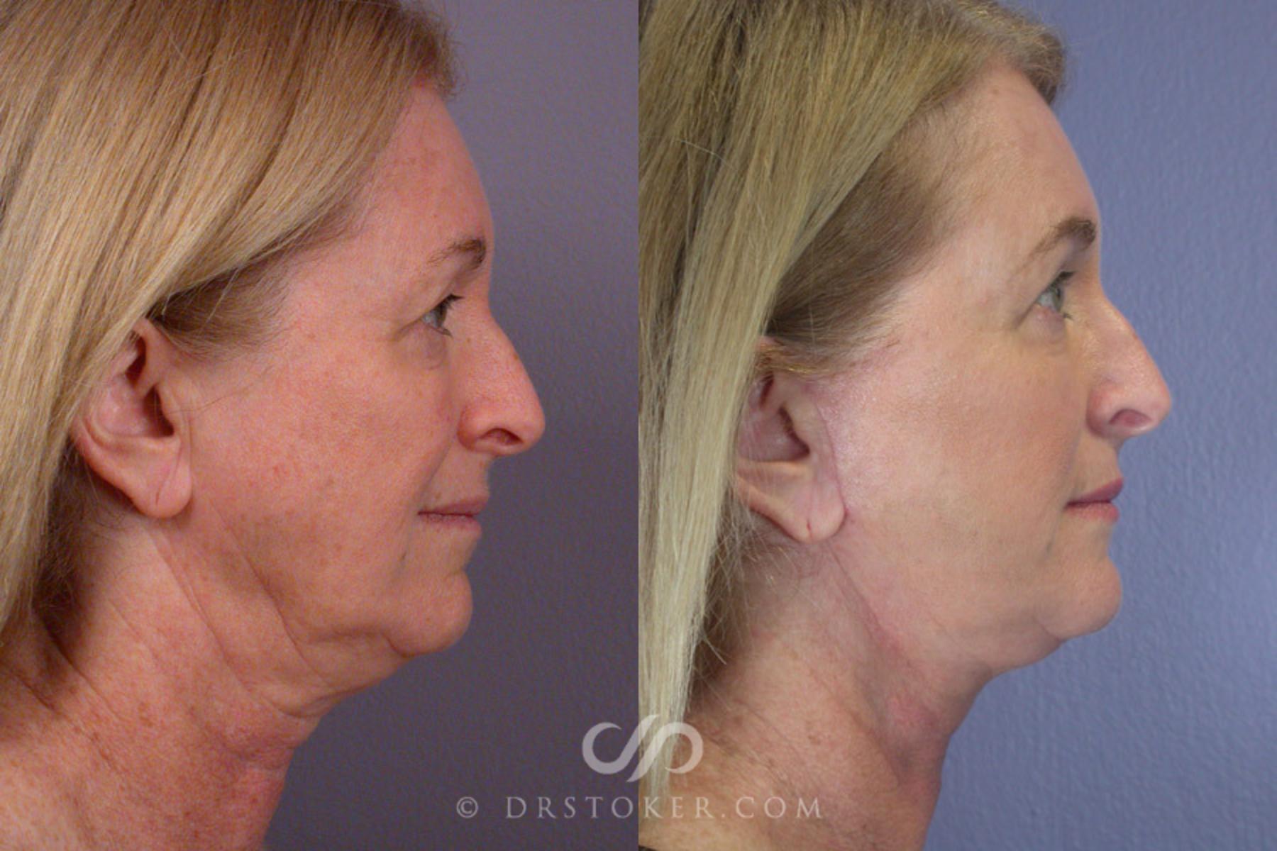 Before & After Neck Lift - Traceless Neck Lift  Case 250 View #4 View in Los Angeles, CA