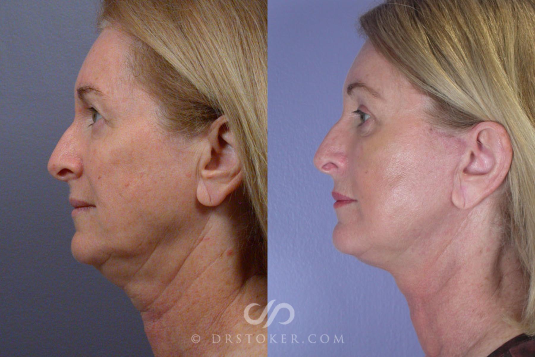 Before & After Neck Lift - Traceless Neck Lift  Case 250 View #5 View in Los Angeles, CA