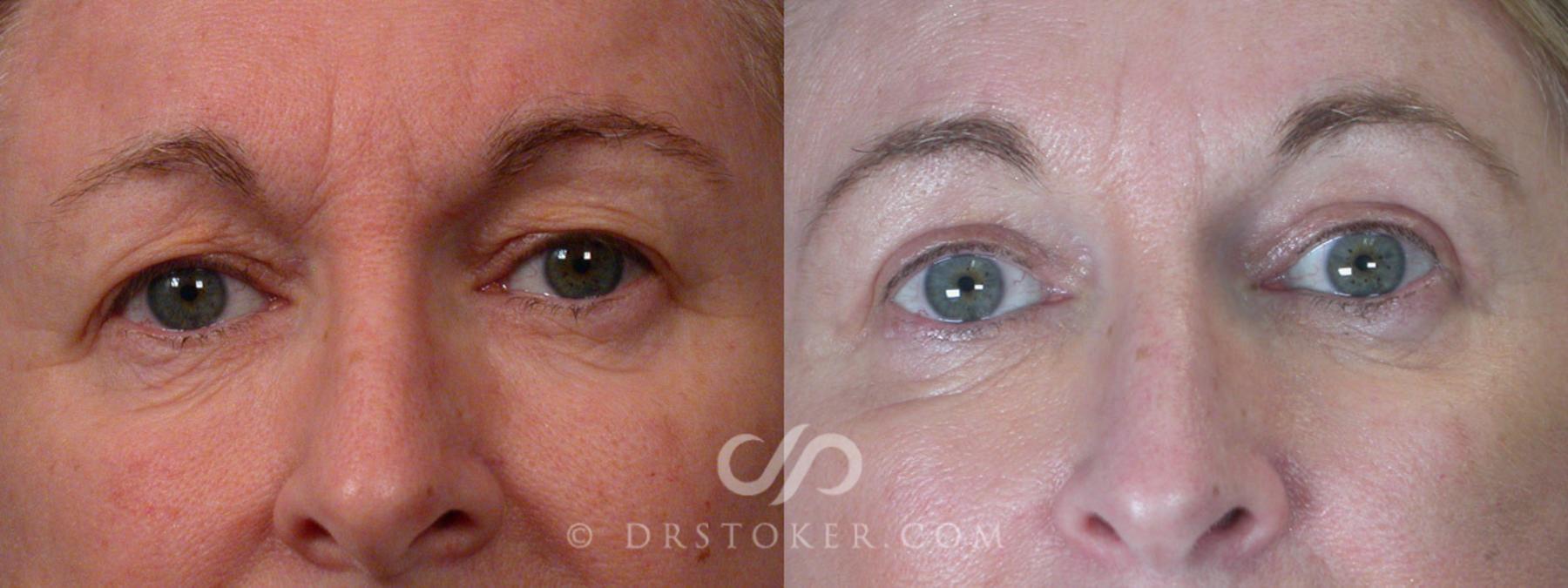 Before & After Eyelid Surgery Case 250 View #6 View in Los Angeles, CA