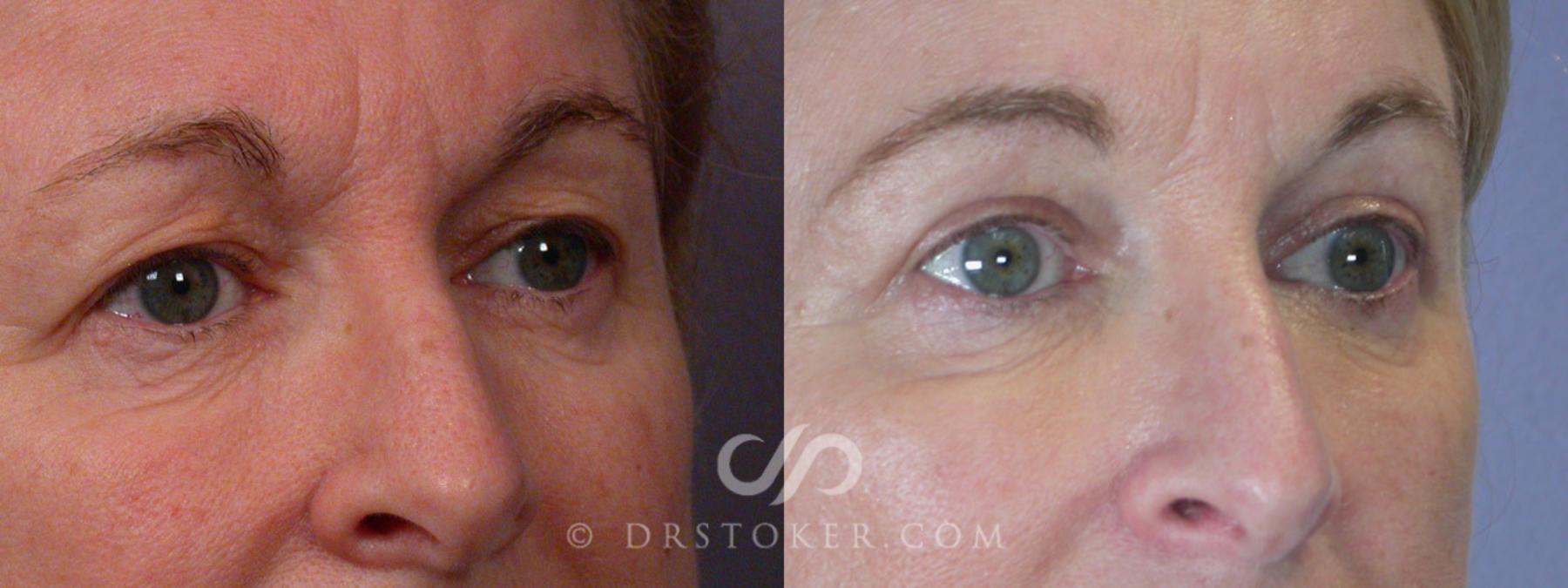 Before & After Facelift - Traceless Facelift Case 250 View #7 View in Los Angeles, CA