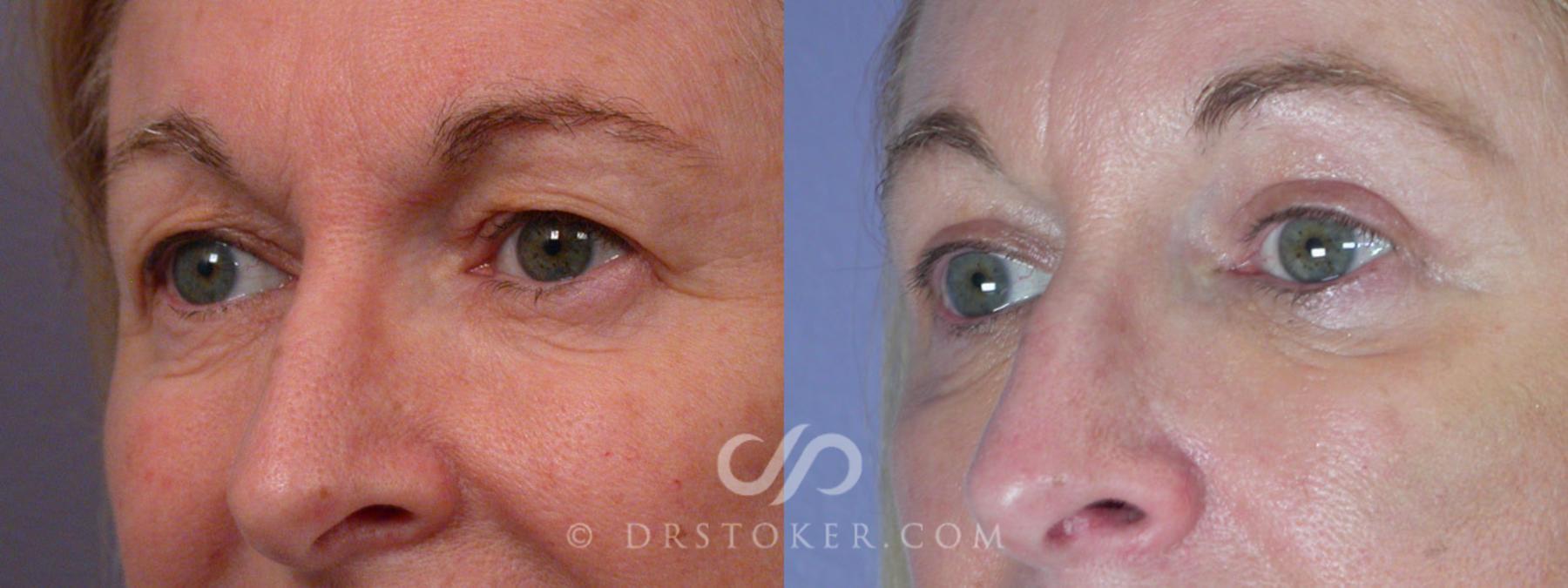Before & After Eyelid Surgery Case 250 View #8 View in Los Angeles, CA