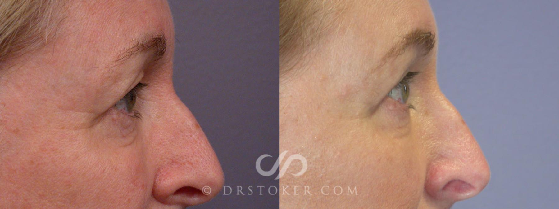 Before & After Eyelid Surgery Case 250 View #9 View in Los Angeles, CA