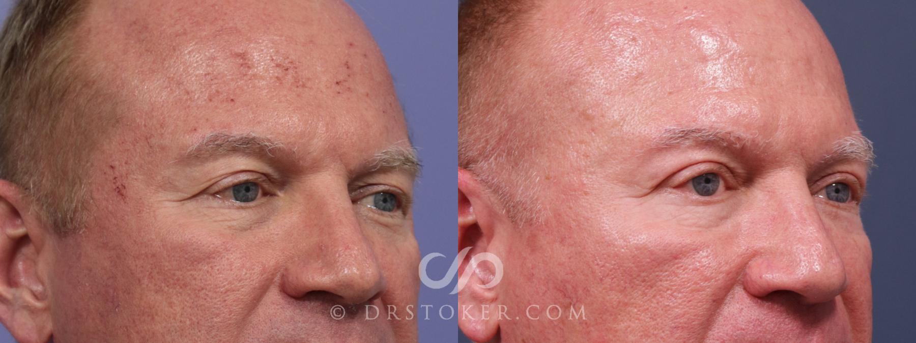 Before & After Laser Skin Resurfacing Eyes Case 2584 Right Oblique View in Los Angeles, CA