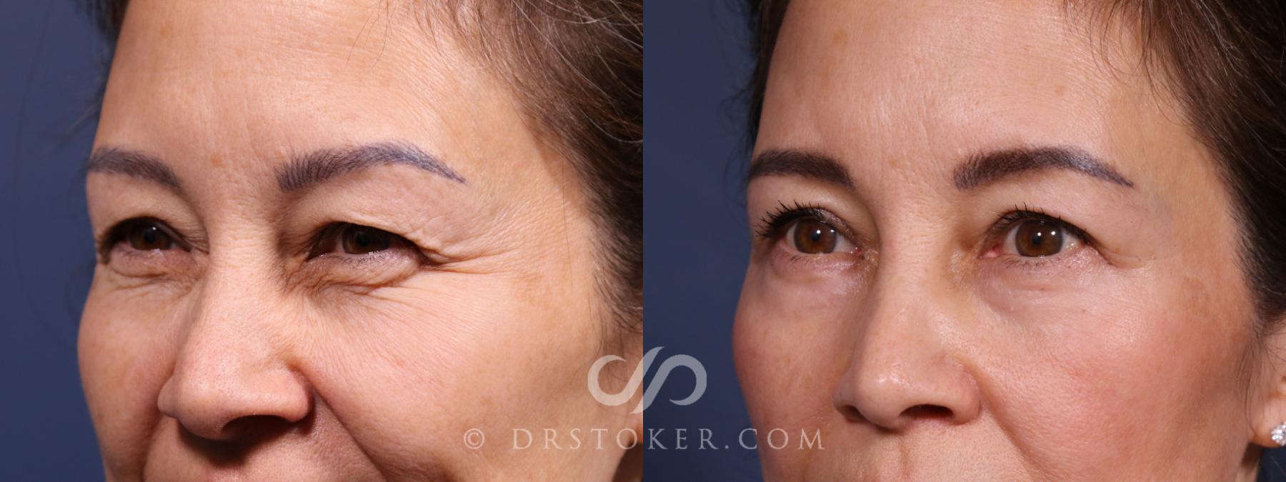 Before & After Laser Skin Resurfacing Eyes Case 2594 Left Oblique View in Los Angeles, CA