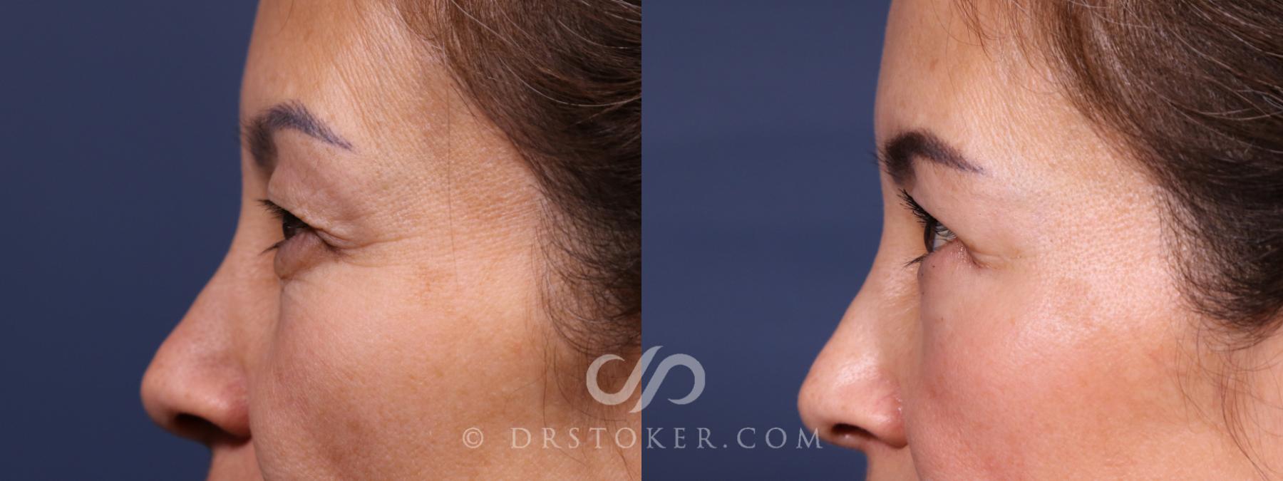 Before & After Laser Skin Resurfacing Eyes Case 2594 Left Side View in Los Angeles, CA