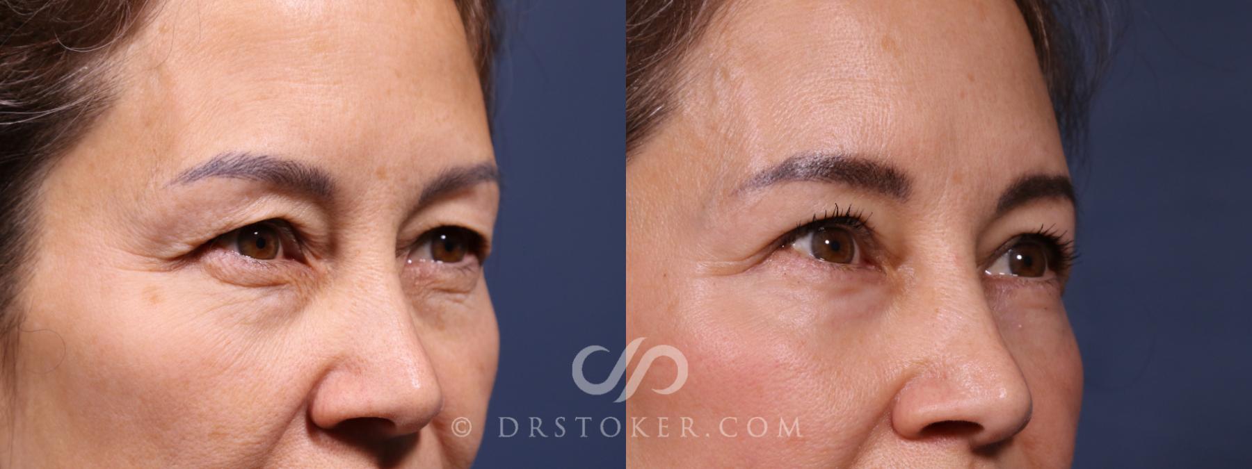 Before & After Laser Skin Resurfacing Eyes Case 2594 Right Oblique View in Los Angeles, CA