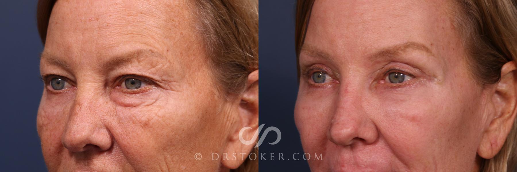 Before & After Eyelid Surgery Case 2603 Left Oblique View in Los Angeles, CA
