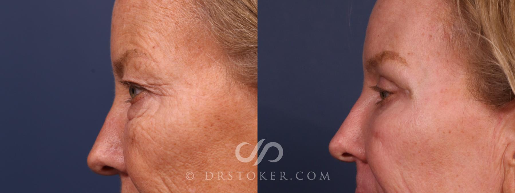 Before & After Eyelid Surgery Case 2603 Left Side View in Los Angeles, CA