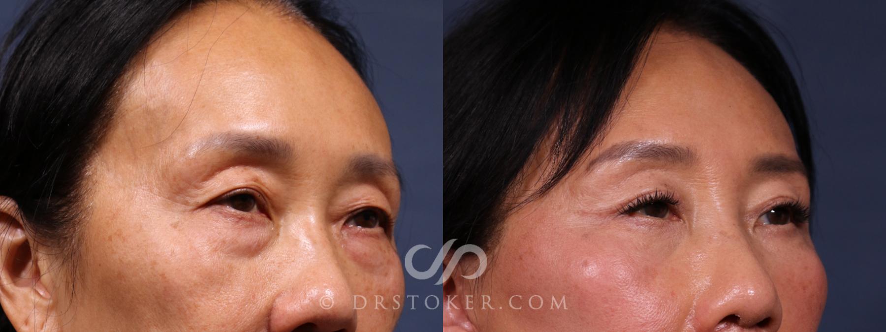 Before & After Eyelid Surgery Case 2613 Right Oblique View in Los Angeles, CA