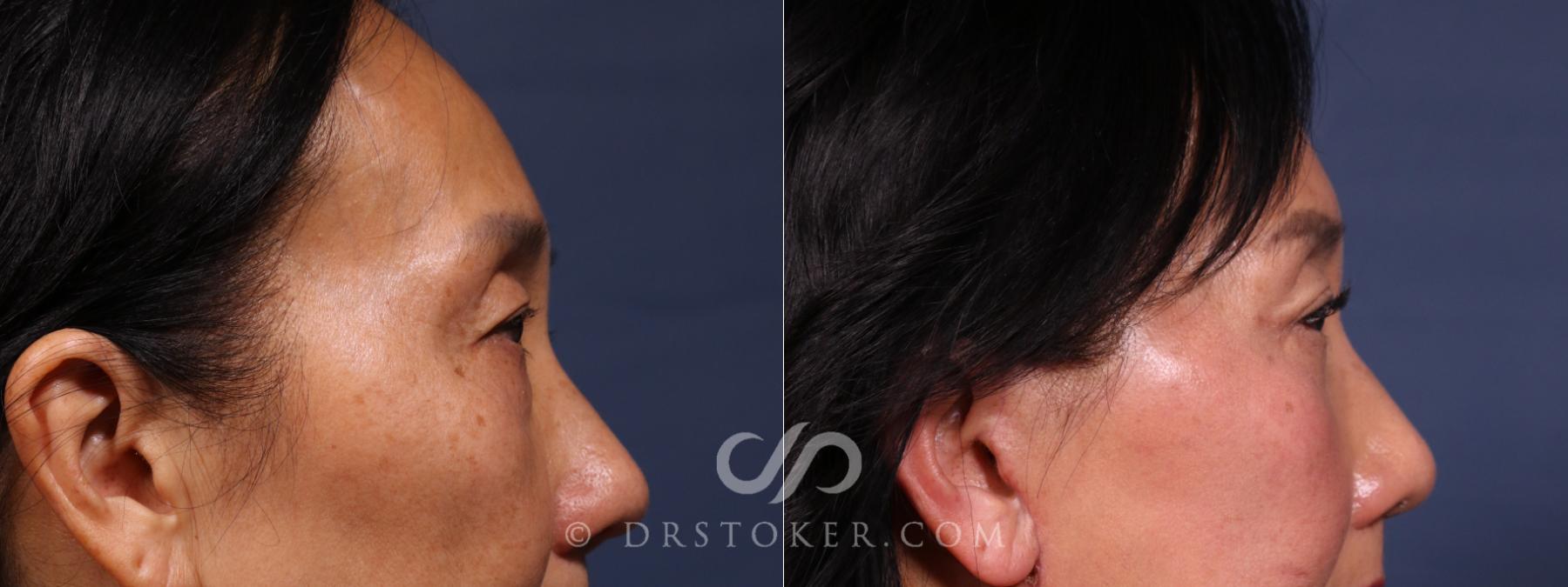 Before & After Eyelid Surgery Case 2613 Right Side View in Los Angeles, CA