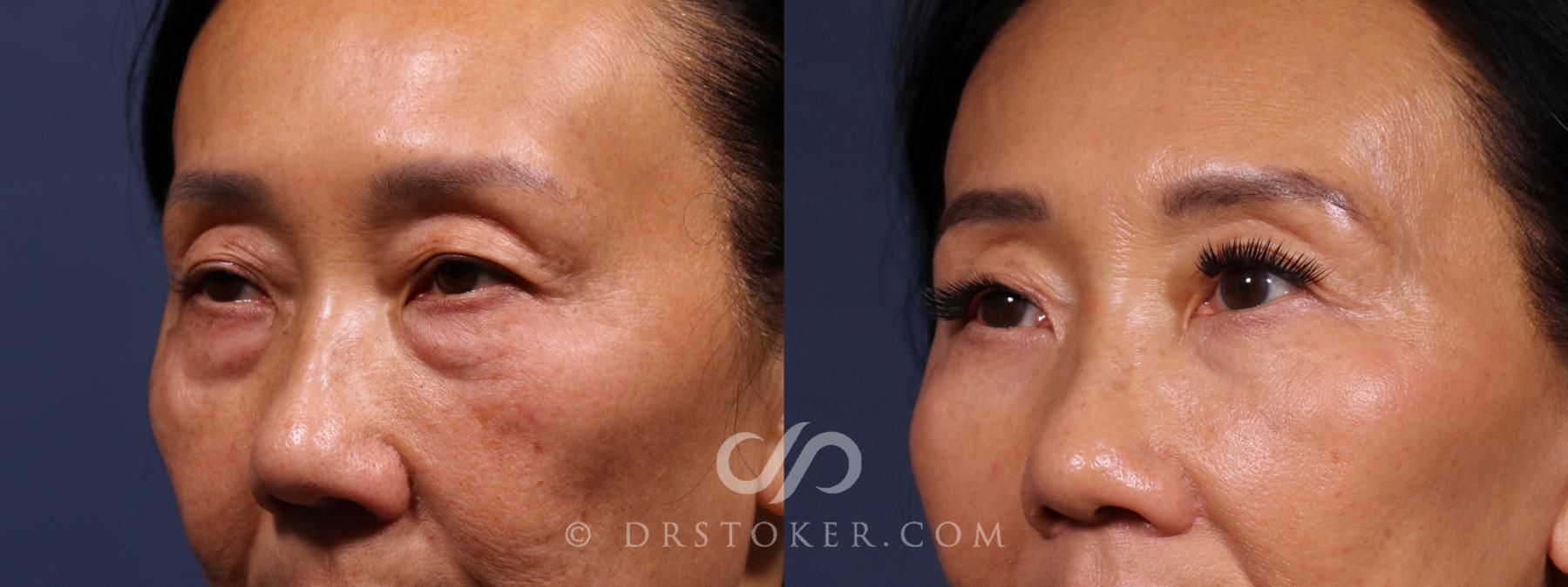 Before & After Eyelid Surgery Case 2623 Left Oblique View in Los Angeles, CA
