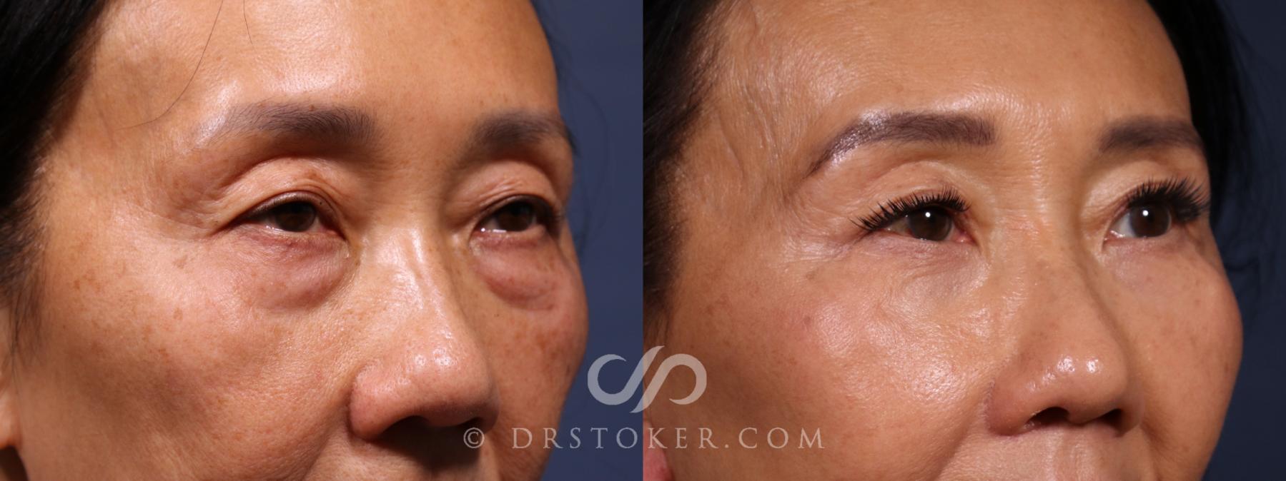 Before & After Eyelid Surgery Case 2623 Right Oblique View in Los Angeles, CA