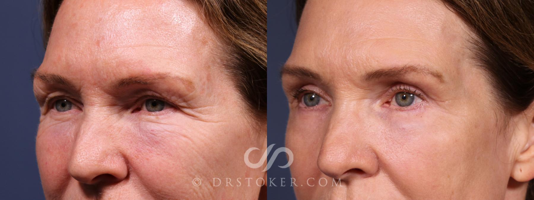 Before & After Eyelid Surgery Case 2635 Left Oblique View in Los Angeles, CA