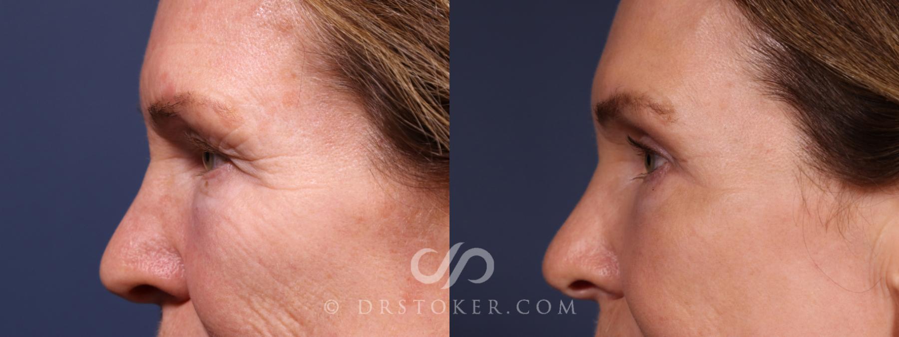 Before & After Eyelid Surgery Case 2635 Left Side View in Los Angeles, CA