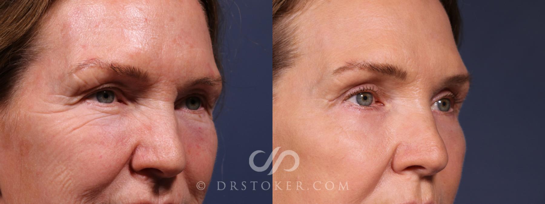 Before & After Eyelid Surgery Case 2635 Right Oblique View in Los Angeles, CA