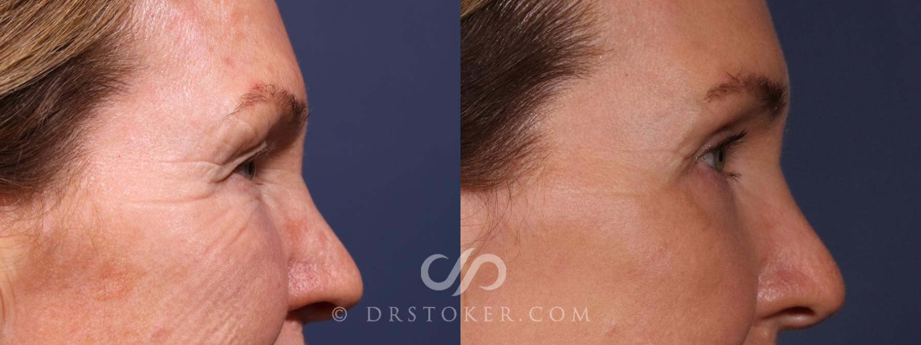 Before & After Eyelid Surgery Case 2635 Right Side View in Los Angeles, CA