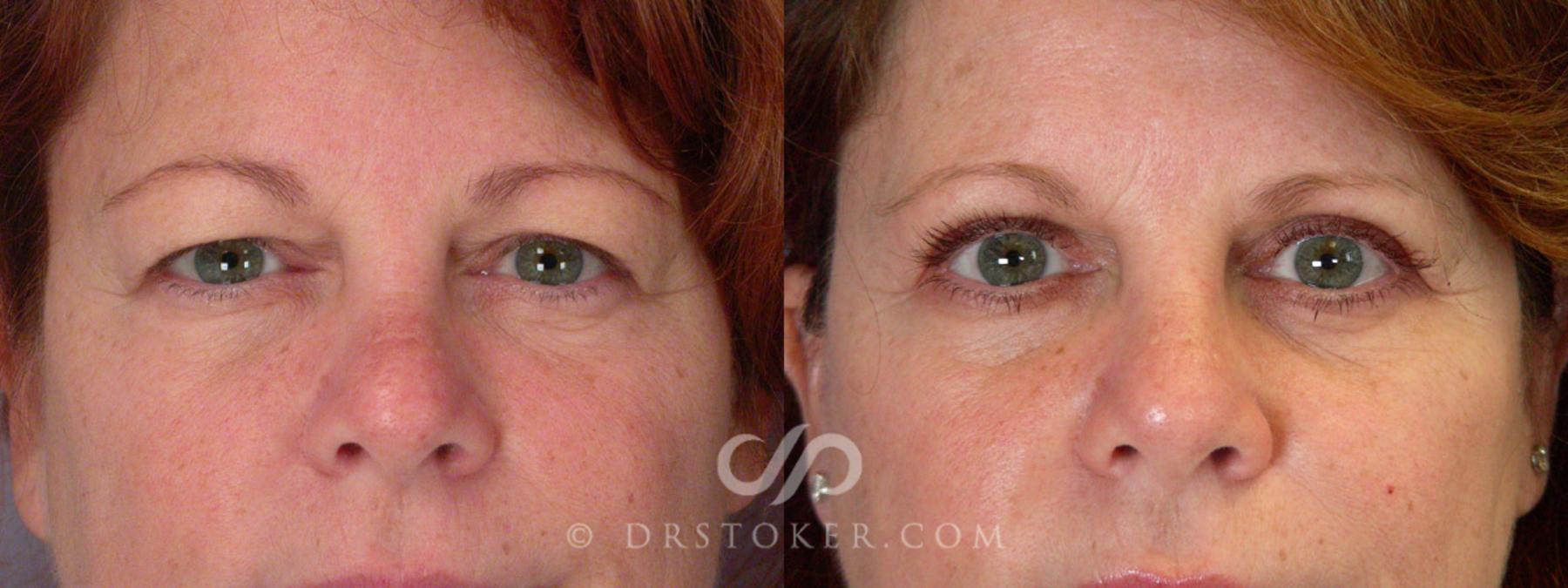 Before & After Eyelid Surgery Case 298 View #1 View in Los Angeles, CA