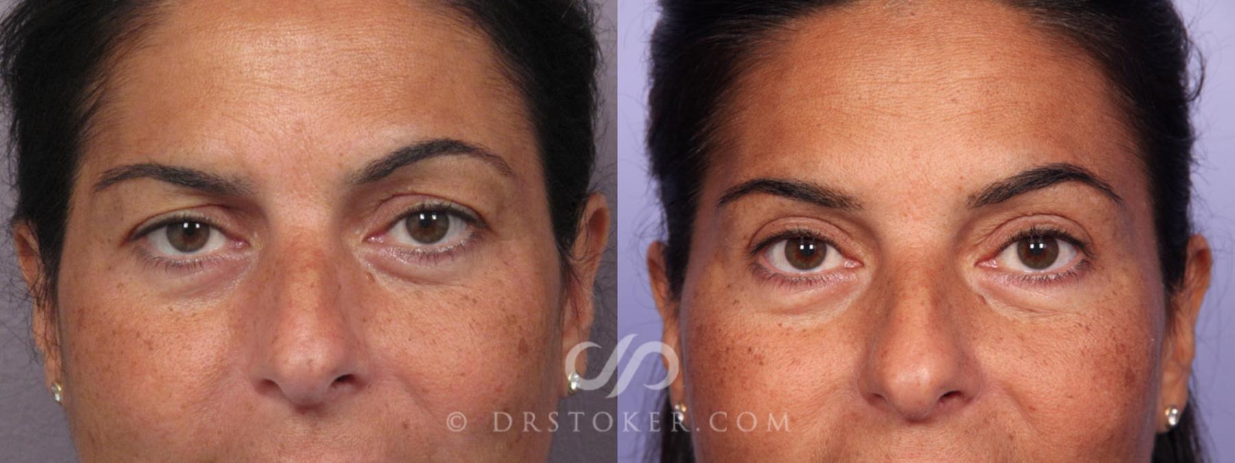 Before & After Eyelid Surgery Case 299 View #1 View in Los Angeles, CA