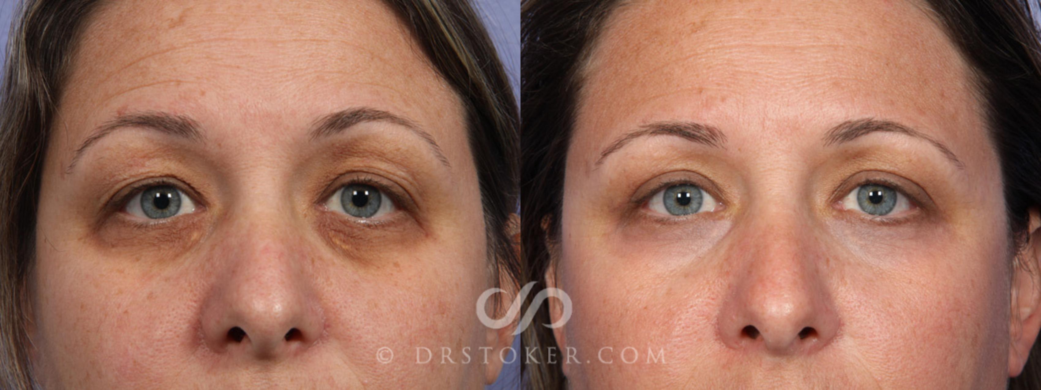 Before & After Eyelid Surgery Case 368 View #1 View in Marina del Rey, CA