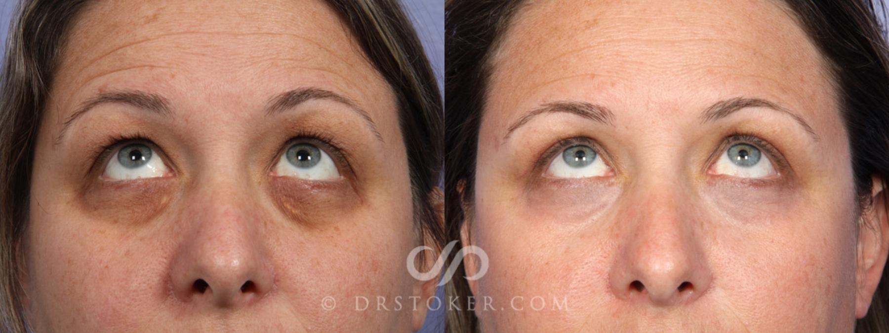 Before & After Laser Skin Resurfacing Case 368 View #2 View in Los Angeles, CA