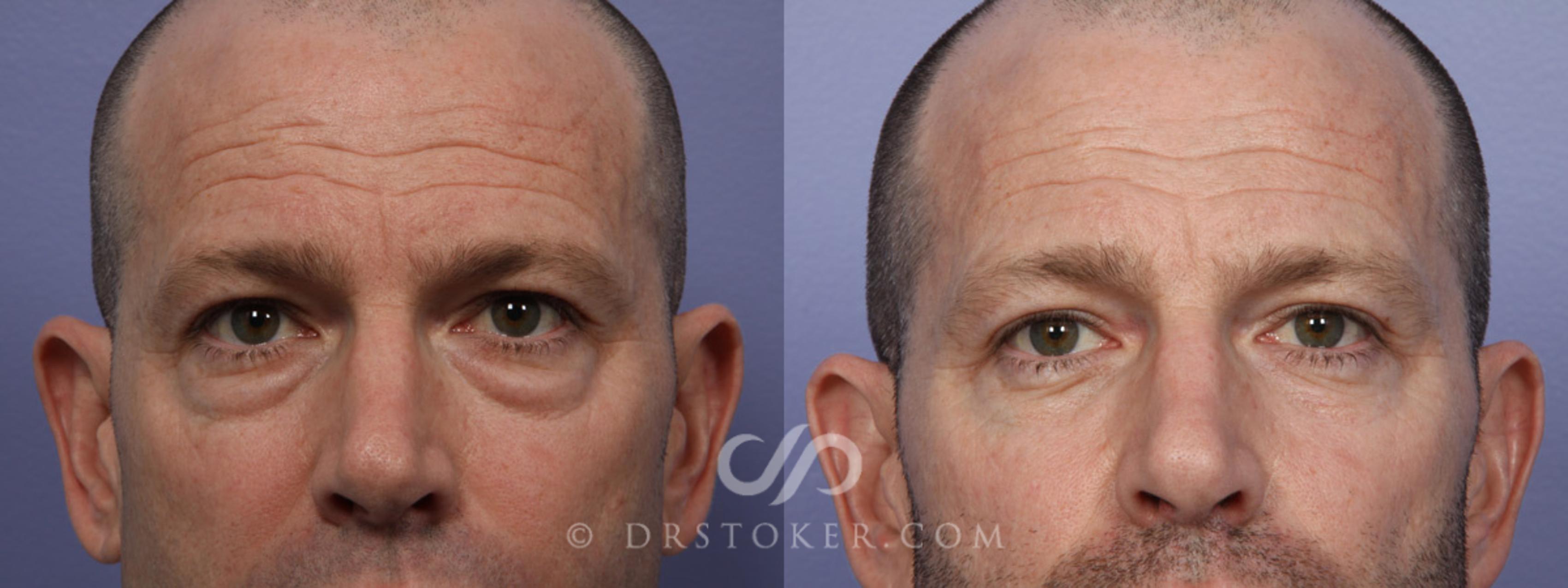 Before & After Eyelid Surgery for Men Case 369 View #1 View in Marina del Rey, CA