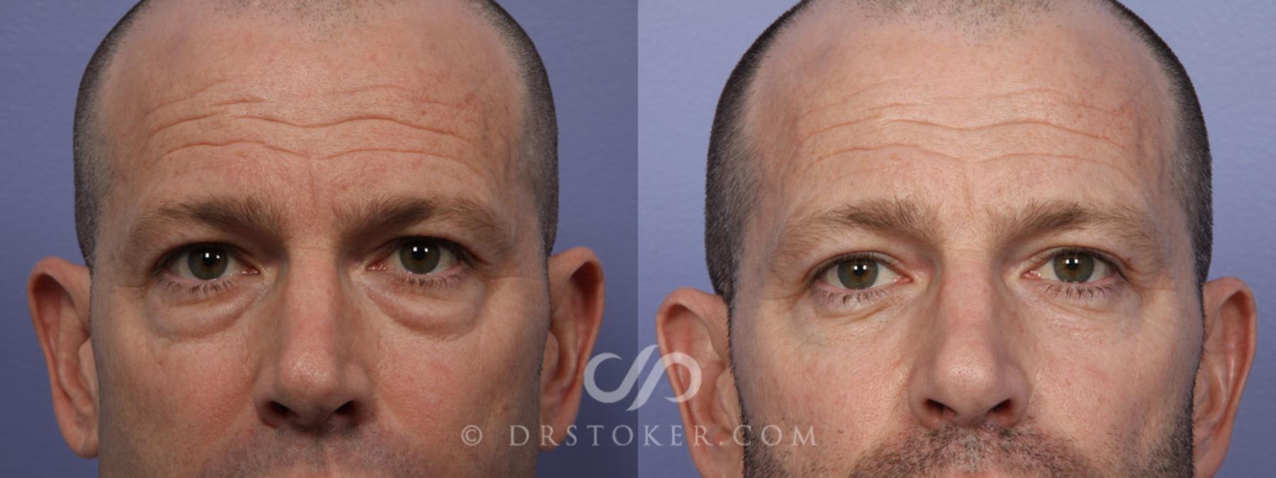 Before & After Eyelid Surgery for Men Case 369 View #1 View in Los Angeles, CA