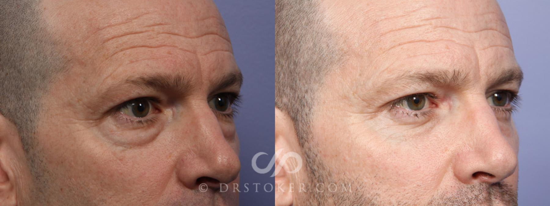Before & After Eyelid Surgery Case 369 View #3 View in Los Angeles, CA