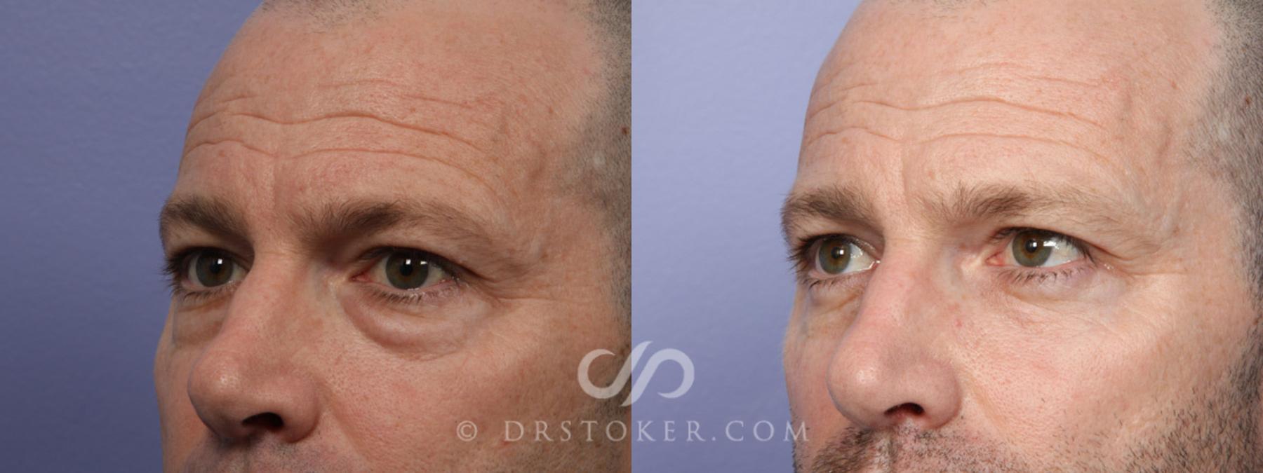 Before & After Eyelid Surgery for Men Case 369 View #4 View in Los Angeles, CA