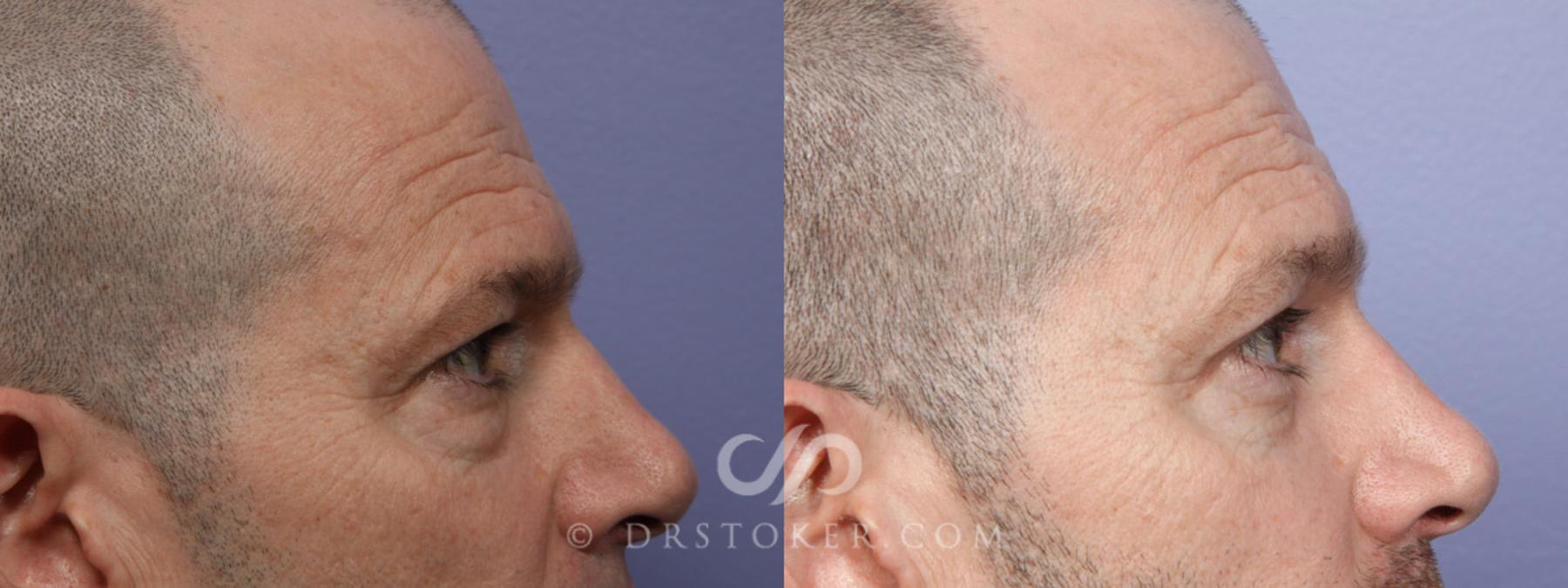Before & After Eyelid Surgery for Men Case 369 View #5 View in Los Angeles, CA