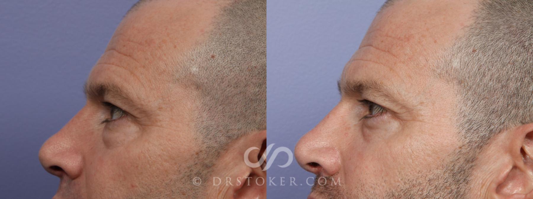 Before & After Eyelid Surgery Case 369 View #6 View in Los Angeles, CA