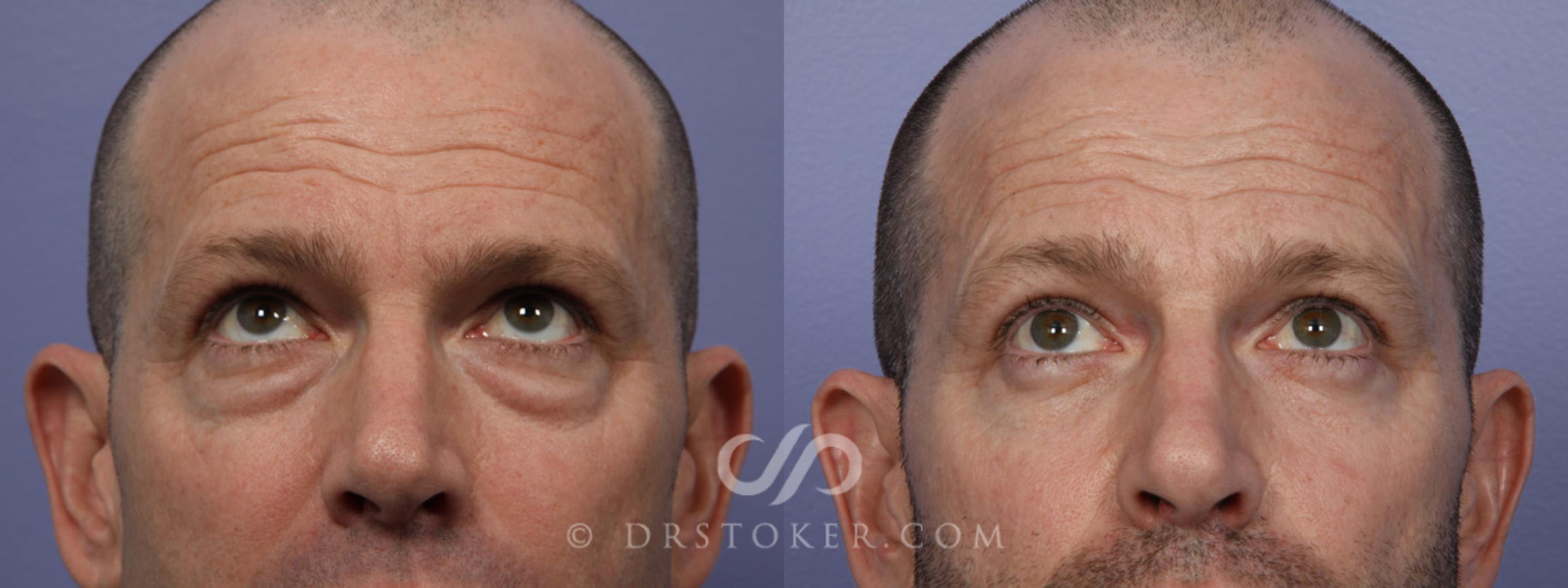 Before & After Eyelid Surgery Case 369 View #7 View in Los Angeles, CA