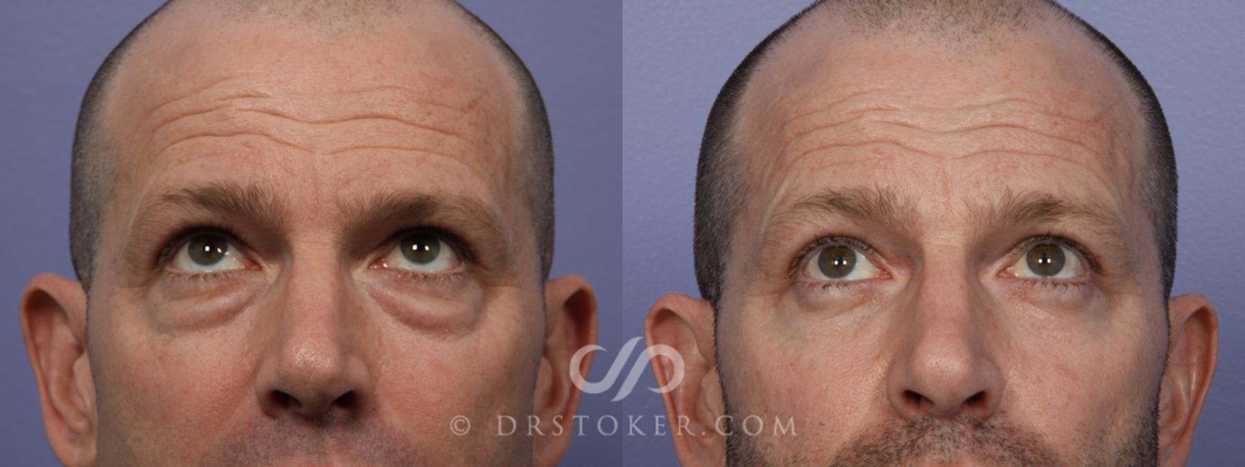 Before & After Eyelid Surgery Case 369 View #7 View in Los Angeles, CA
