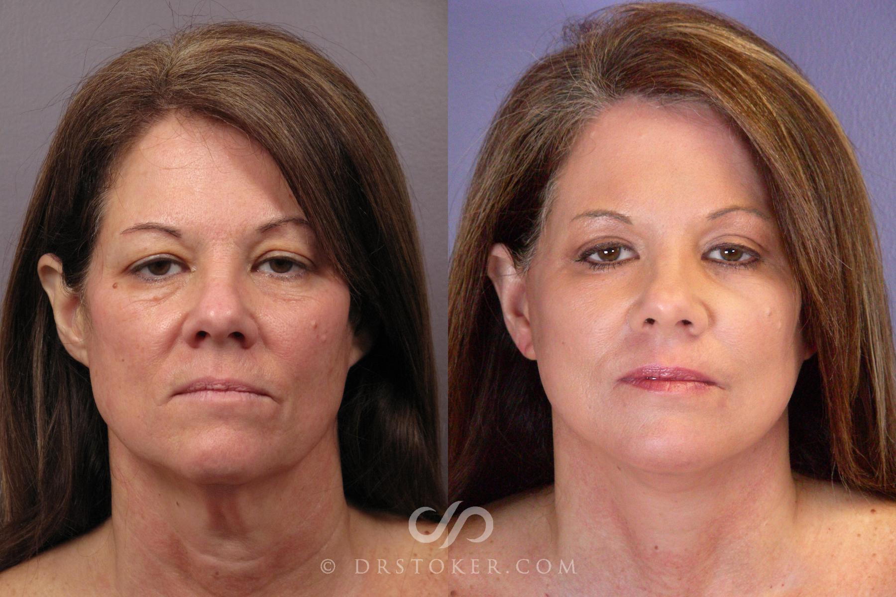Before & After Laser Skin Resurfacing Case 381 View #1 View in Los Angeles, CA