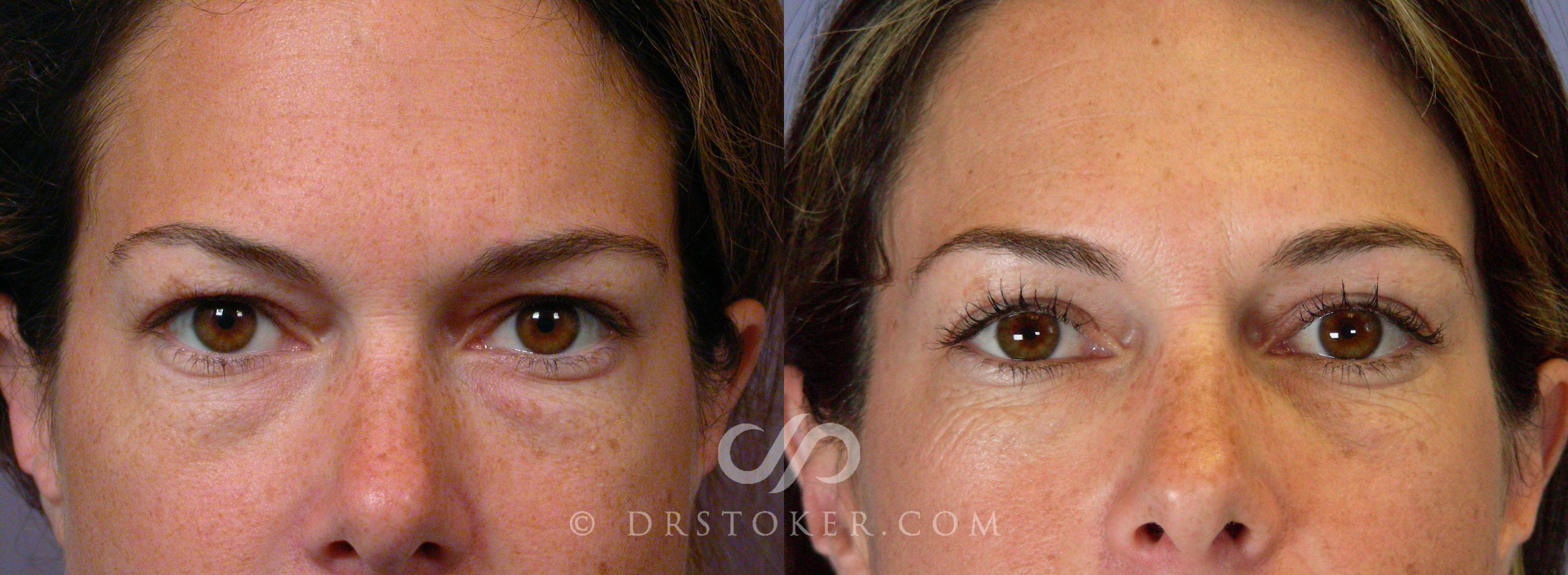 Before & After Eyelid Surgery Case 389 View #1 View in Los Angeles, CA